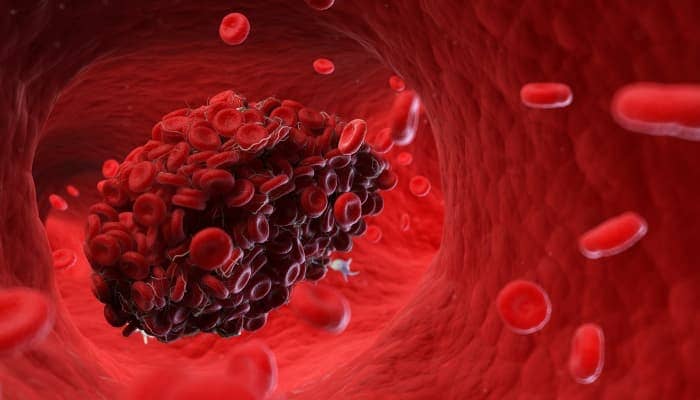 Thrombose veineuse profonde : comprendre, repérer et agir