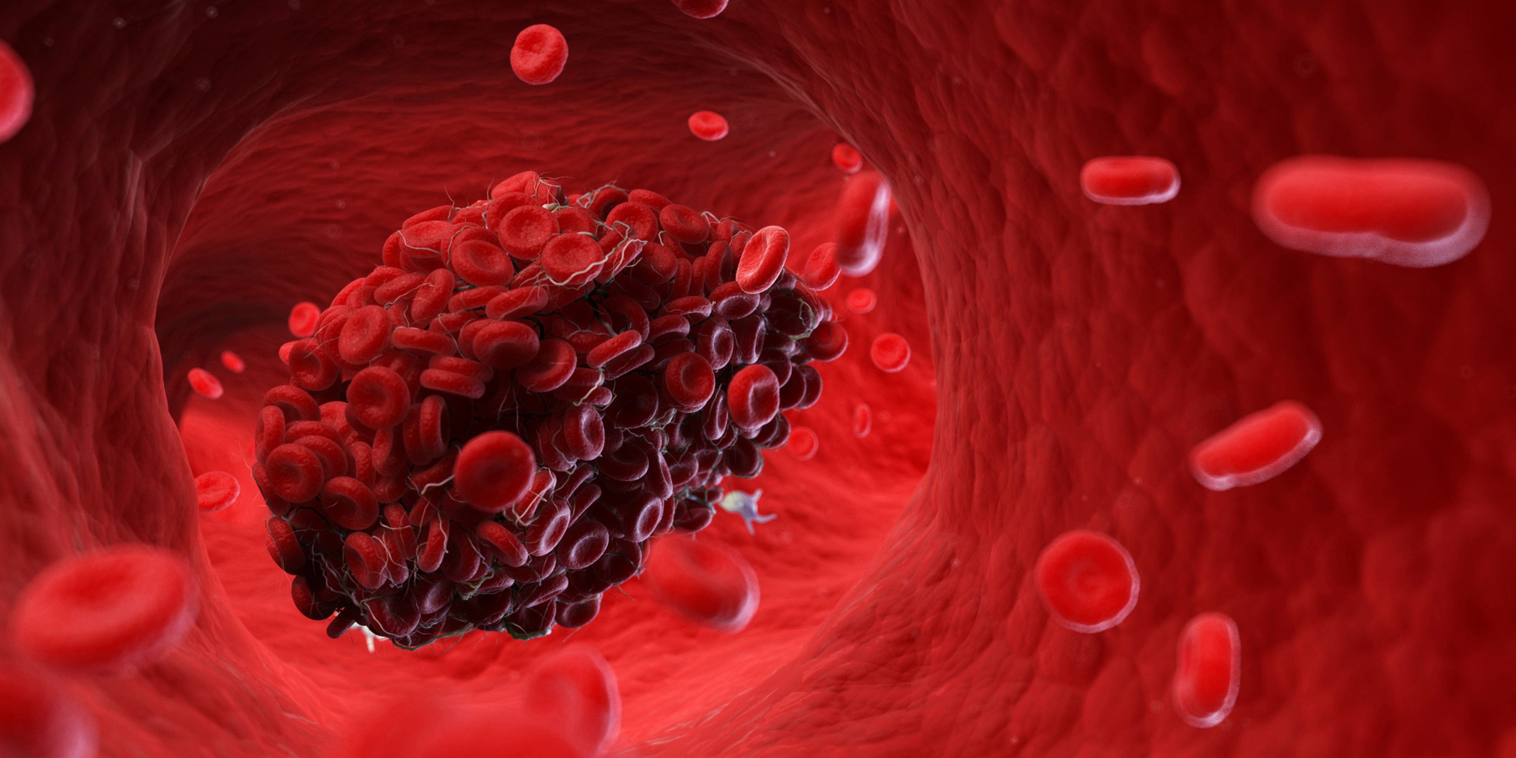 Thrombose veineuse profonde : comprendre, repérer et agir